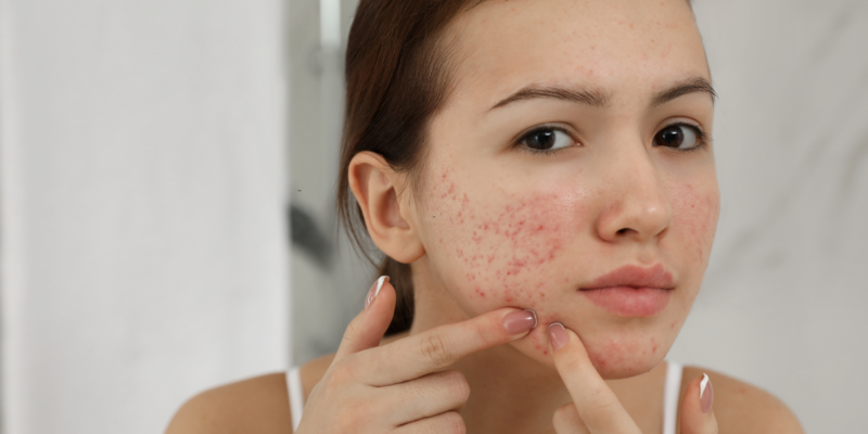 Acne and clogged pores