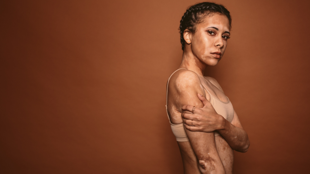 Blemishes And Pigmentation: What'S Really On Your Skin? 1 Blemishes And Pigmentation