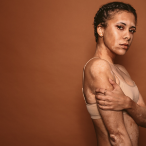 blemishes and pigmentation