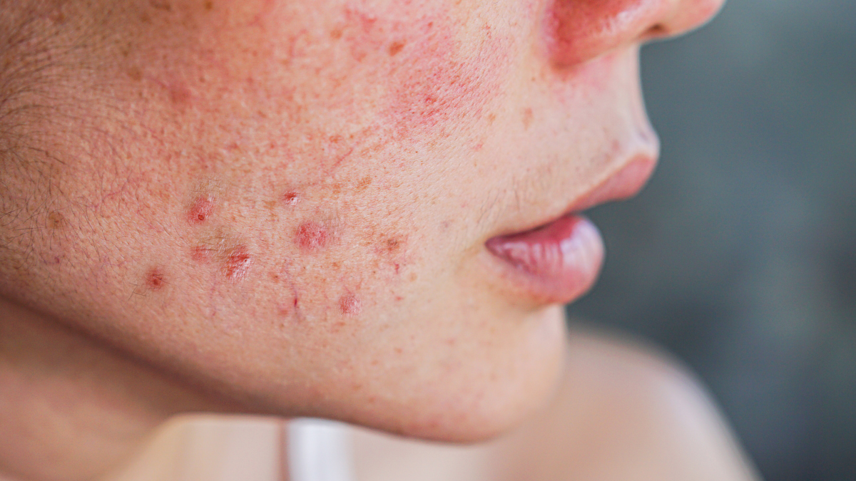 Blemishes And Pigmentation: What'S Really On Your Skin? 4 Blemishes